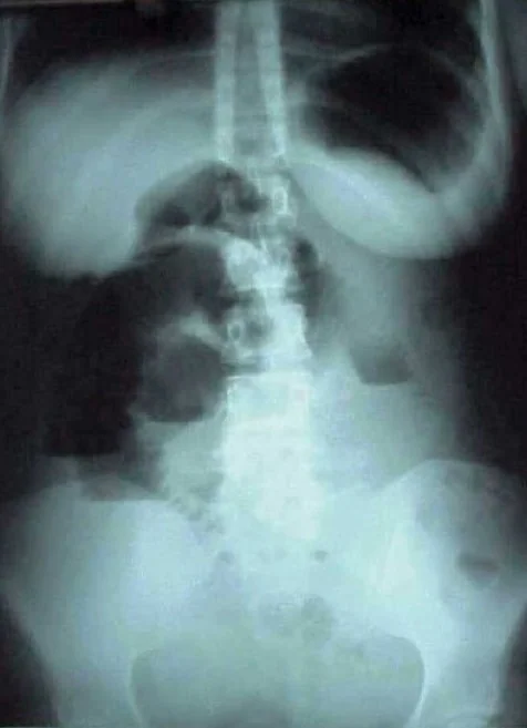 GASTRIC AND INTESTINAL BEZOARS