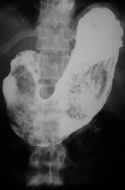 GASTRIC BEZOAR - BARIUM MEAL