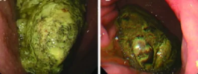 GASTRIC BEZOARS