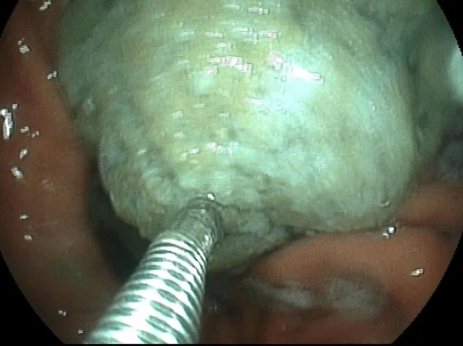 FORCEPS REMOVAL GASTRIC BEZOAR