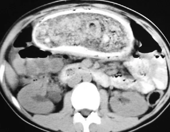 GASTRIC TRICHOBENZOAR - RAPUNZEL SYNDROME 