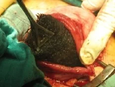 GASTROTOMY - TRICHOBENZOAR