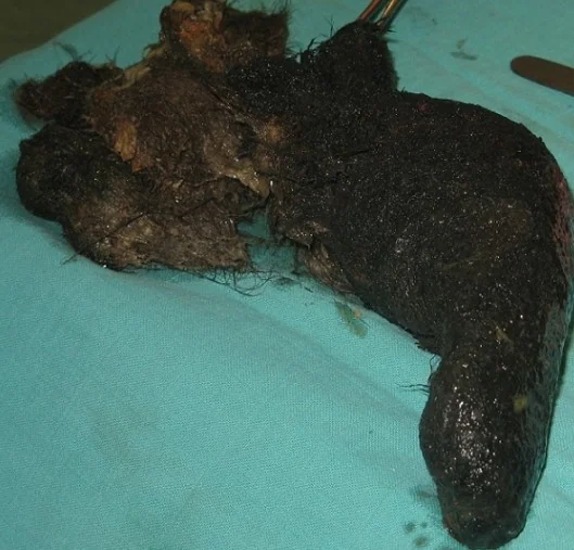 GASTRIC TRICHOBEZOAR 