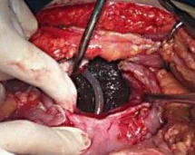 GASTRIC TRICHOLITHOBEZOAR