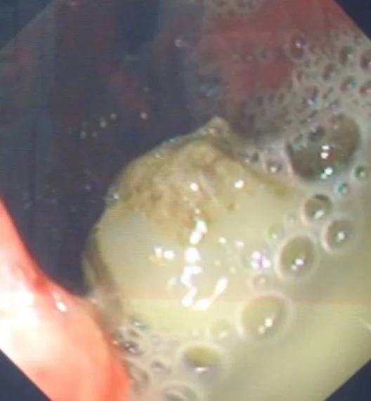 GASTROJEJUNOSTOMY OBSTRUCTION - BEZOAR
