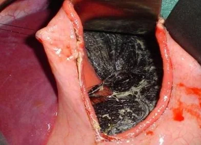 GASTRIC BEZOAR