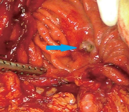 HAIRBALL BEZOAR - GASTRIC ULCER