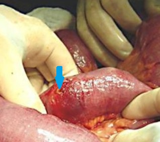 ILEAL BEZOAR - PERFORATION