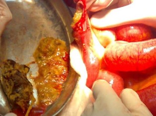 ILEOTOMY - PHYTOBEZOAR