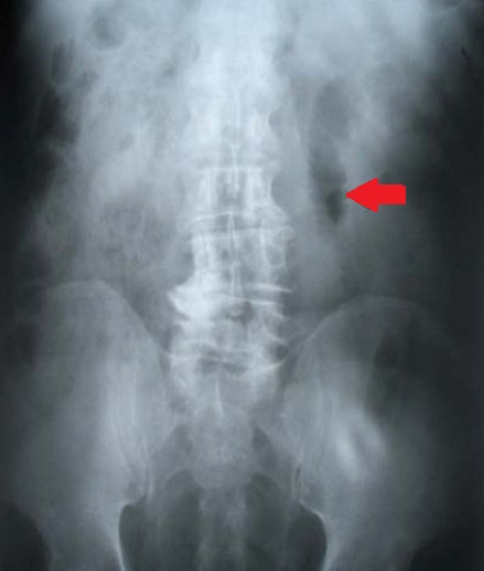 INTESTINAL BEZOAR