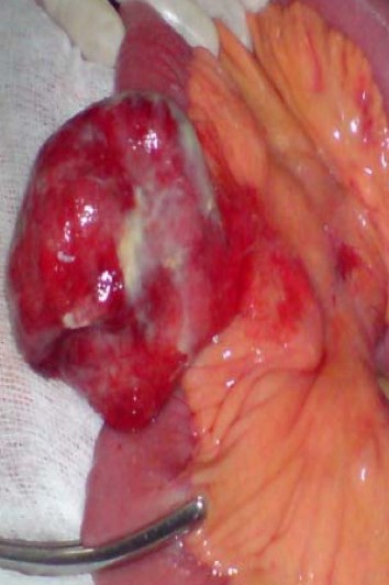 JEJUNAL DIVERTICULUM - BENZOAR 