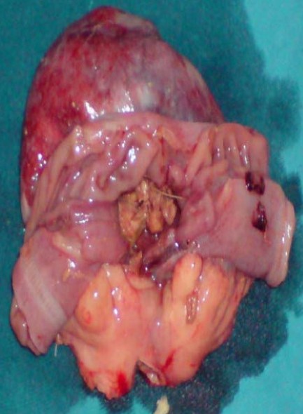 JEJUNAL DIVERTICULUM - BENZOAR
