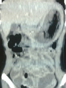 GASTRIC TRICHOBEZOAR 