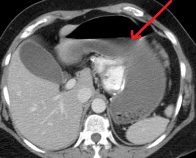 ROUX ANASTOMOSIS OBSTRUCTION - BEZOAR