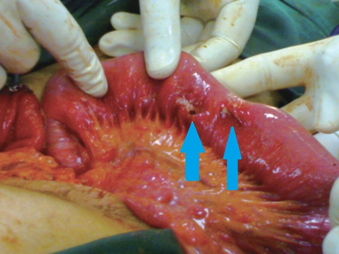 PERFORATIONS PROXIMAL JEJUNUM - GASTRIC BEZOAR
