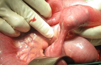 PHYTOBEZOAR - BOWEL OBSTRUCTION 