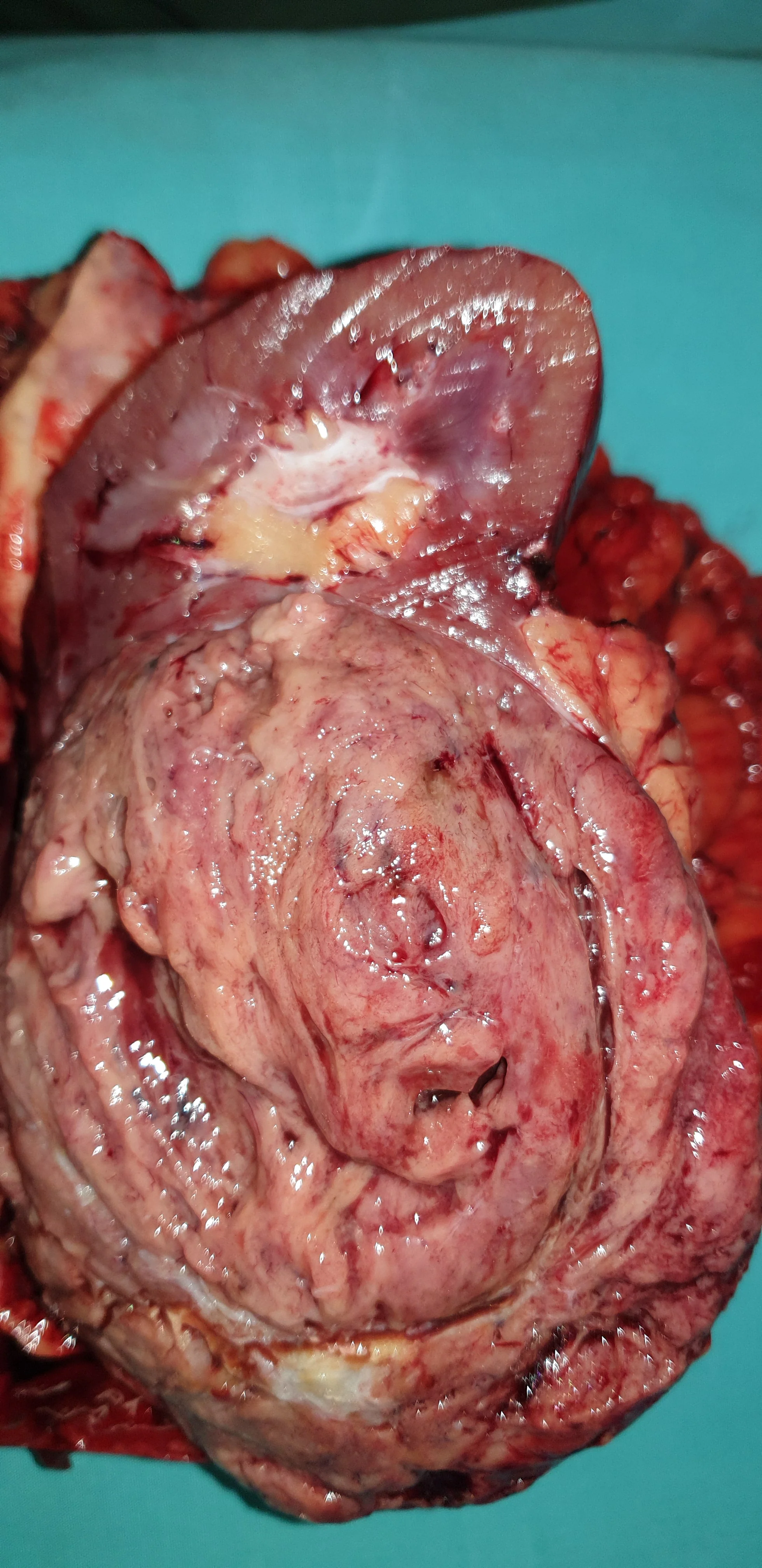 RENAL CARCINOMA