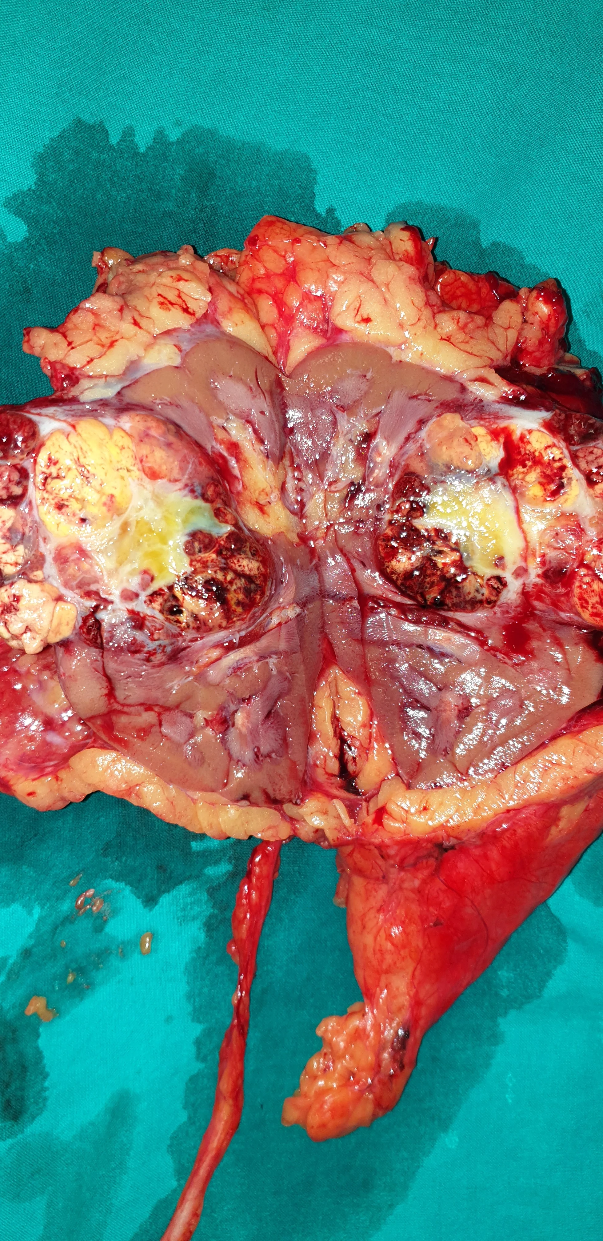 RENAL CARCINOMA