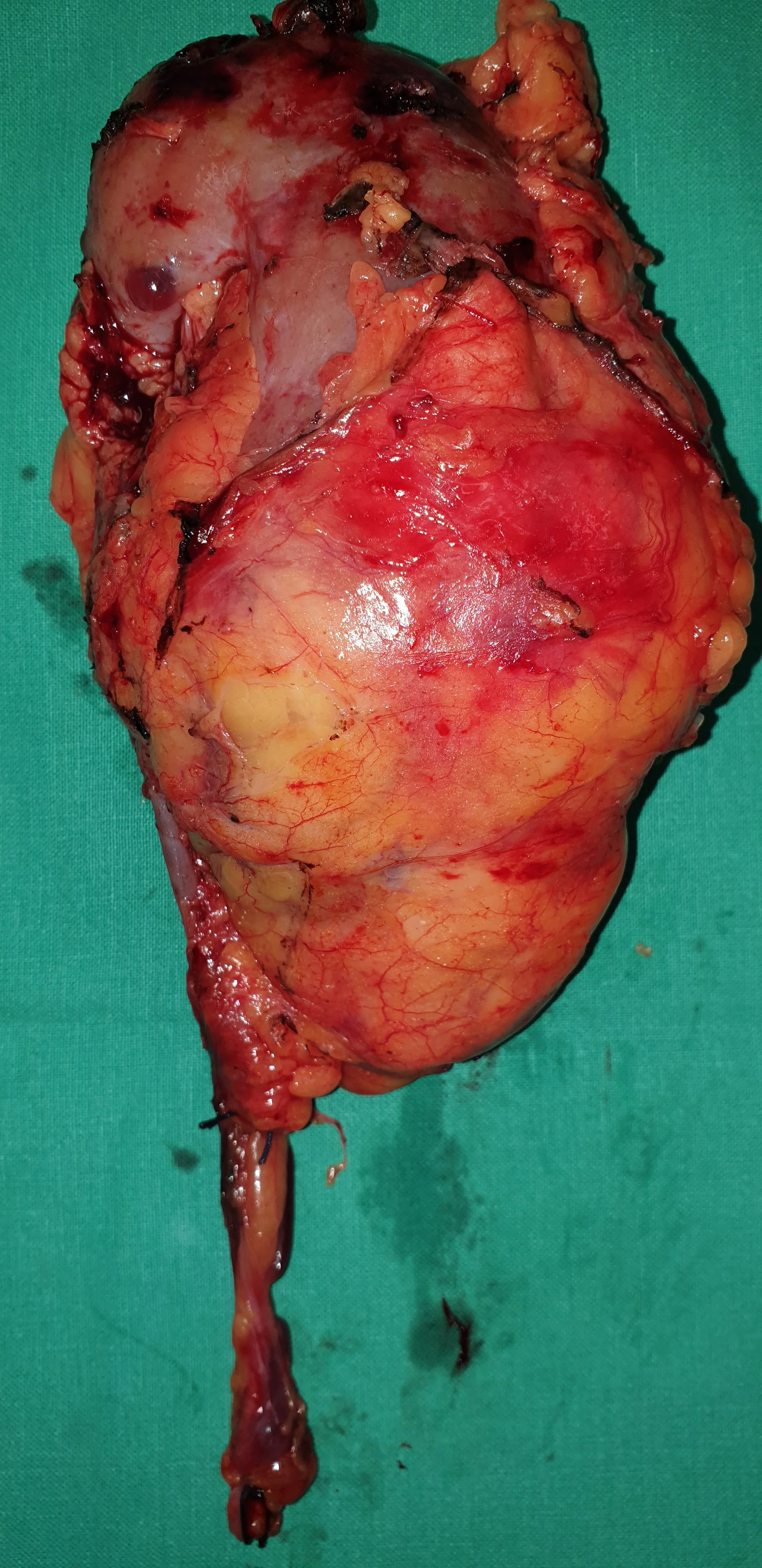RENAL CARCINOMA