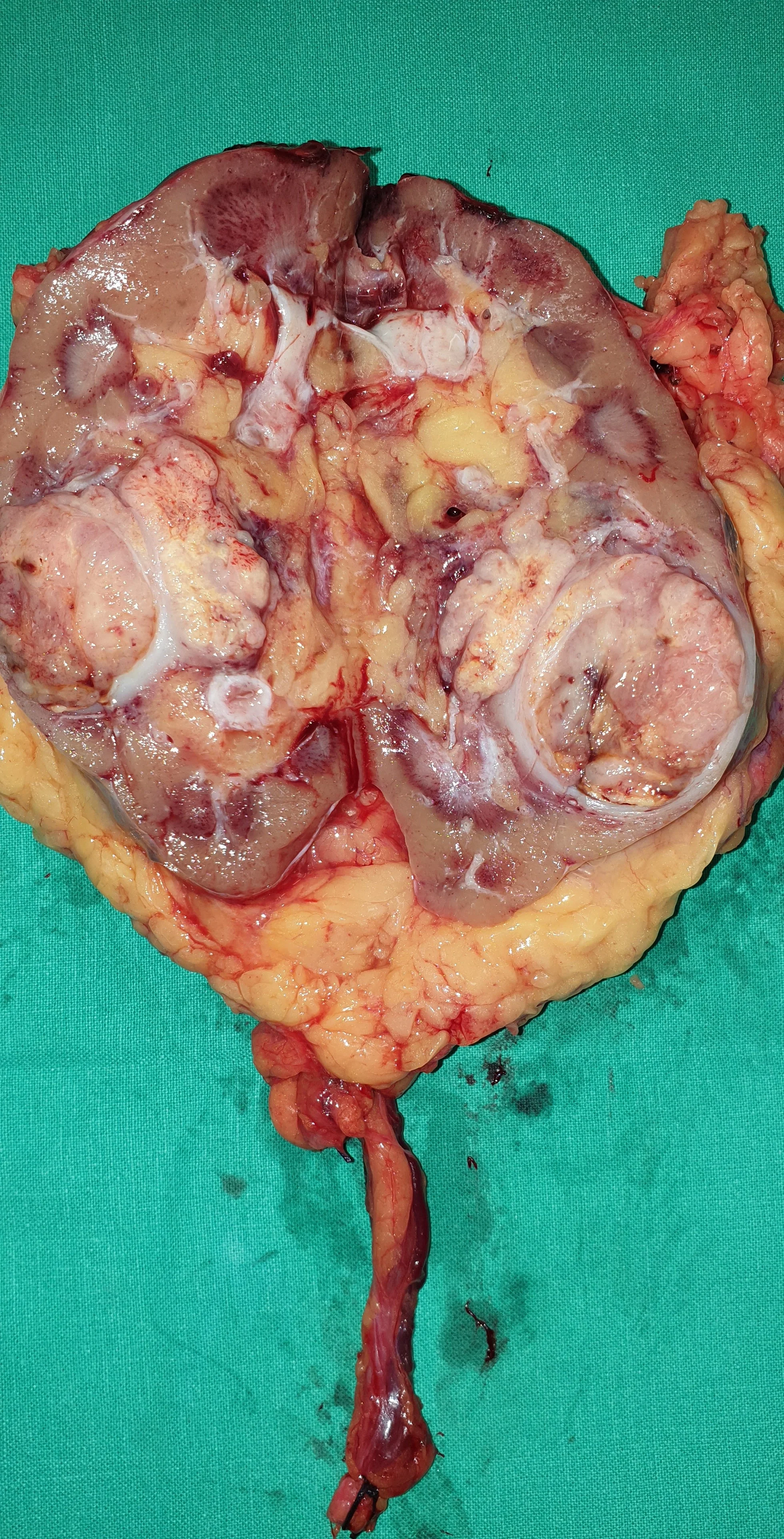 RENAL CARCINOMA