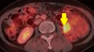 RENAL LEIOMYOSARCOMA