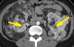 RENAL ANGIOMYOLIPOMAS