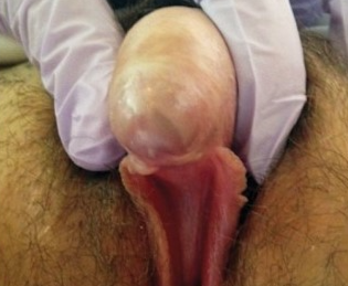 EPIDERMOID CYST CLITORIS 