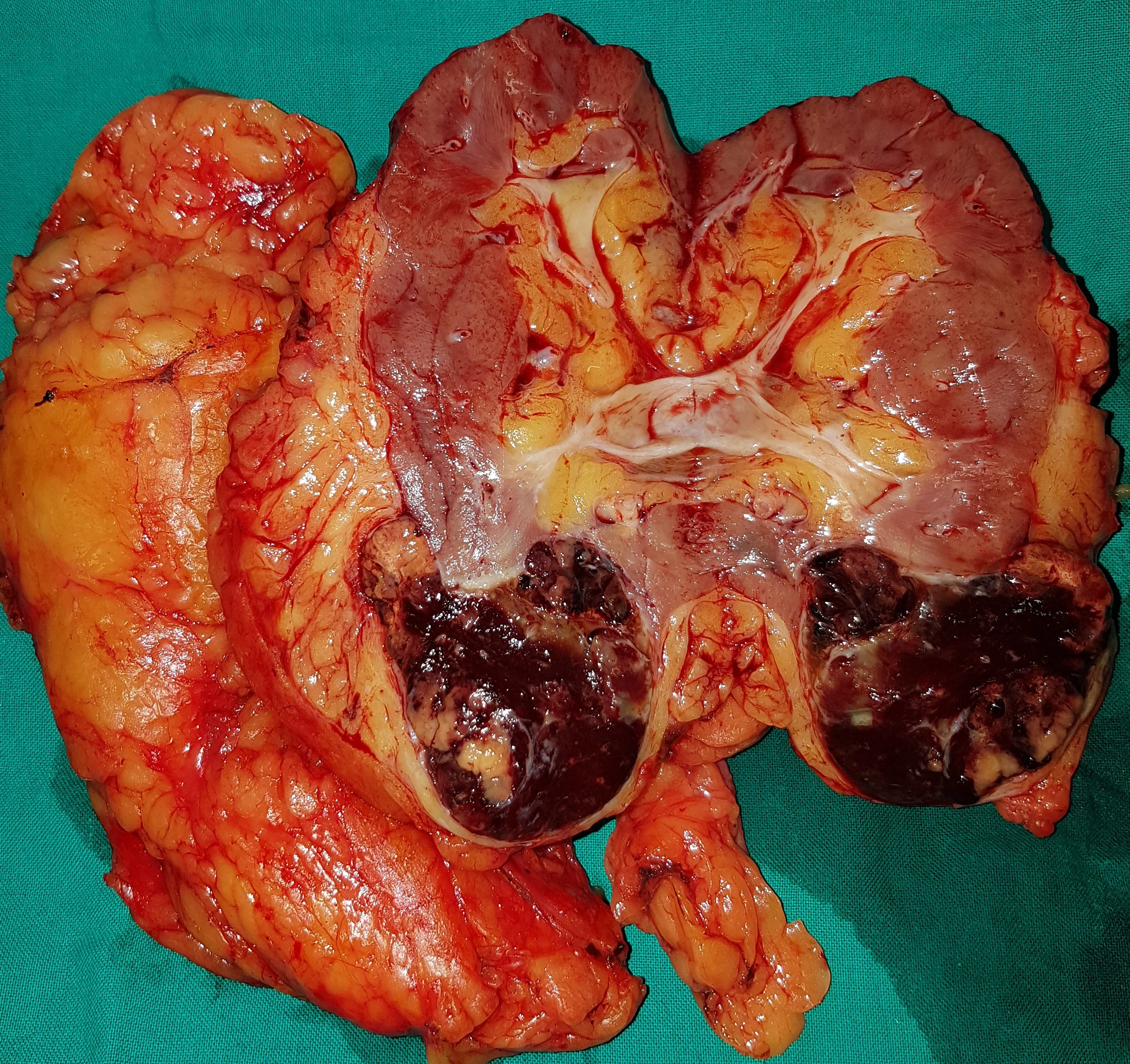 RENAL CARCINOMA