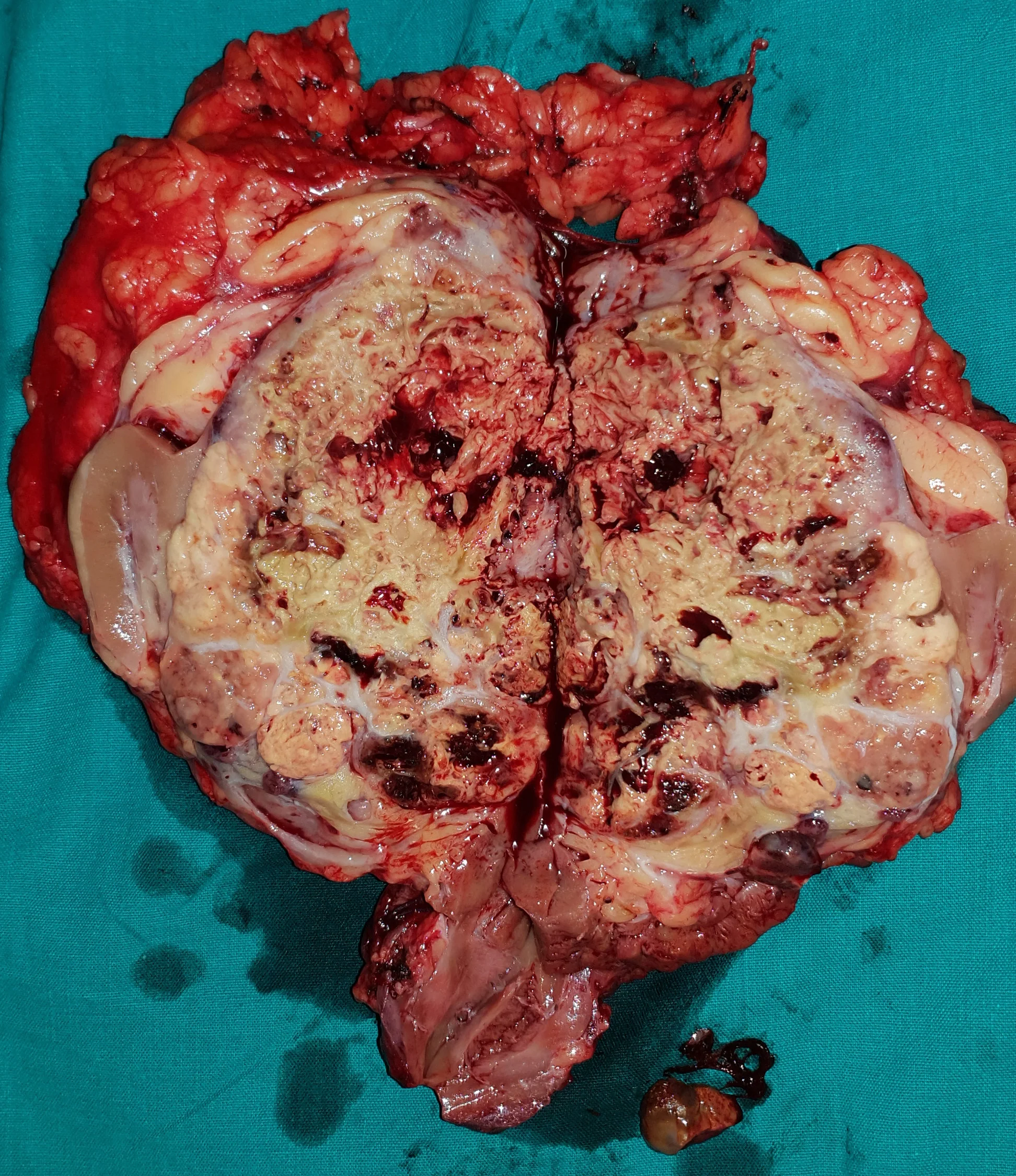 RENAL CARCINOMA