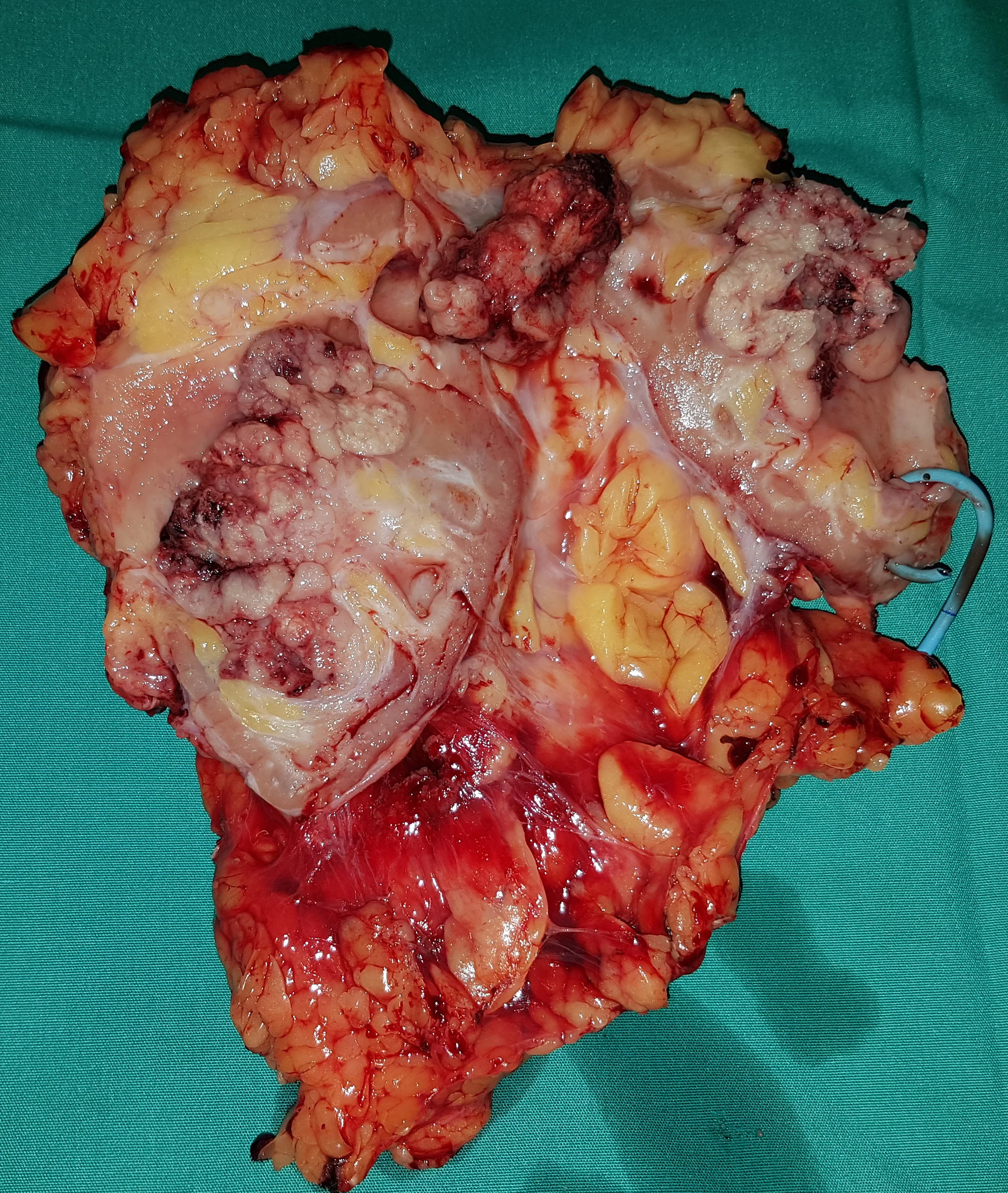 RENAL CARCINOMA