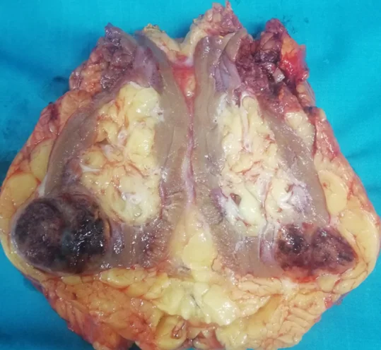 RENAL ONCOCYTOMA