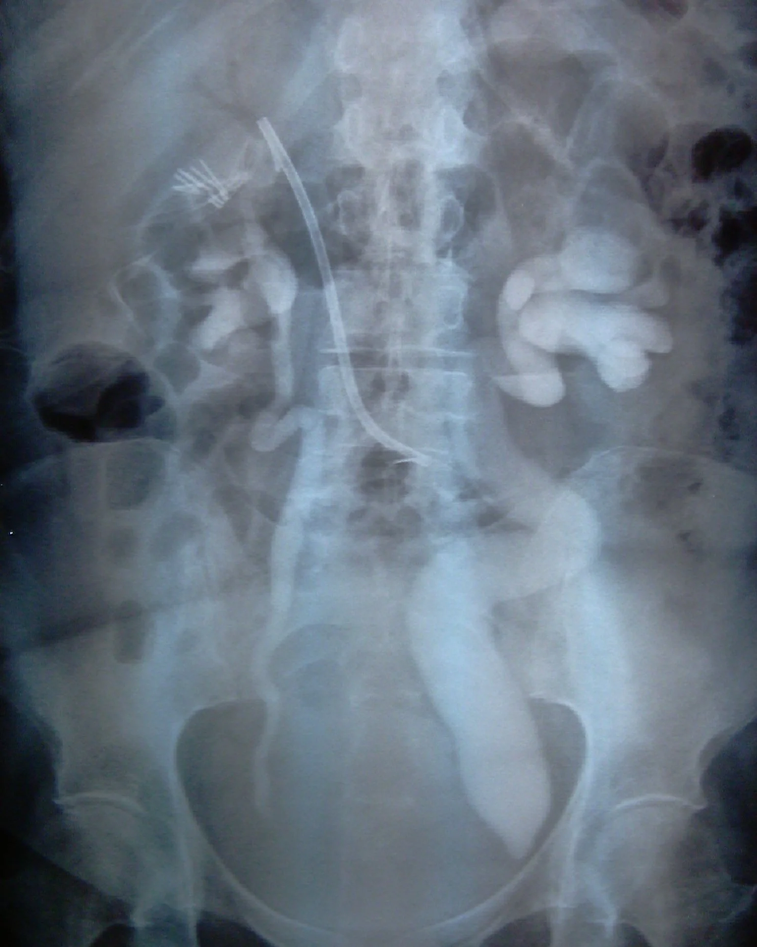 LEFT URETERIC OBSTRUCTION