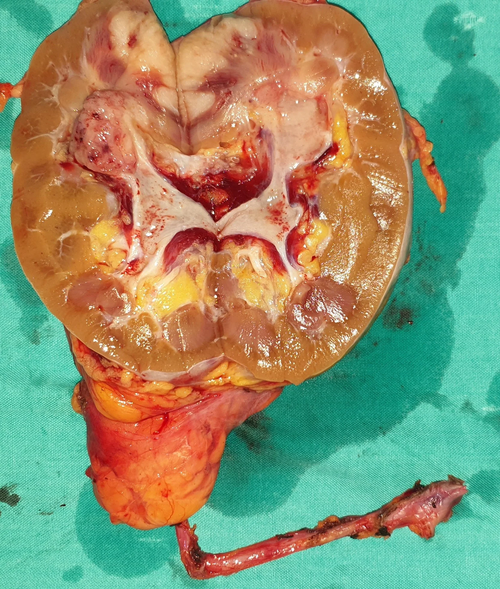 RENAL PELVIS CARCINOMA