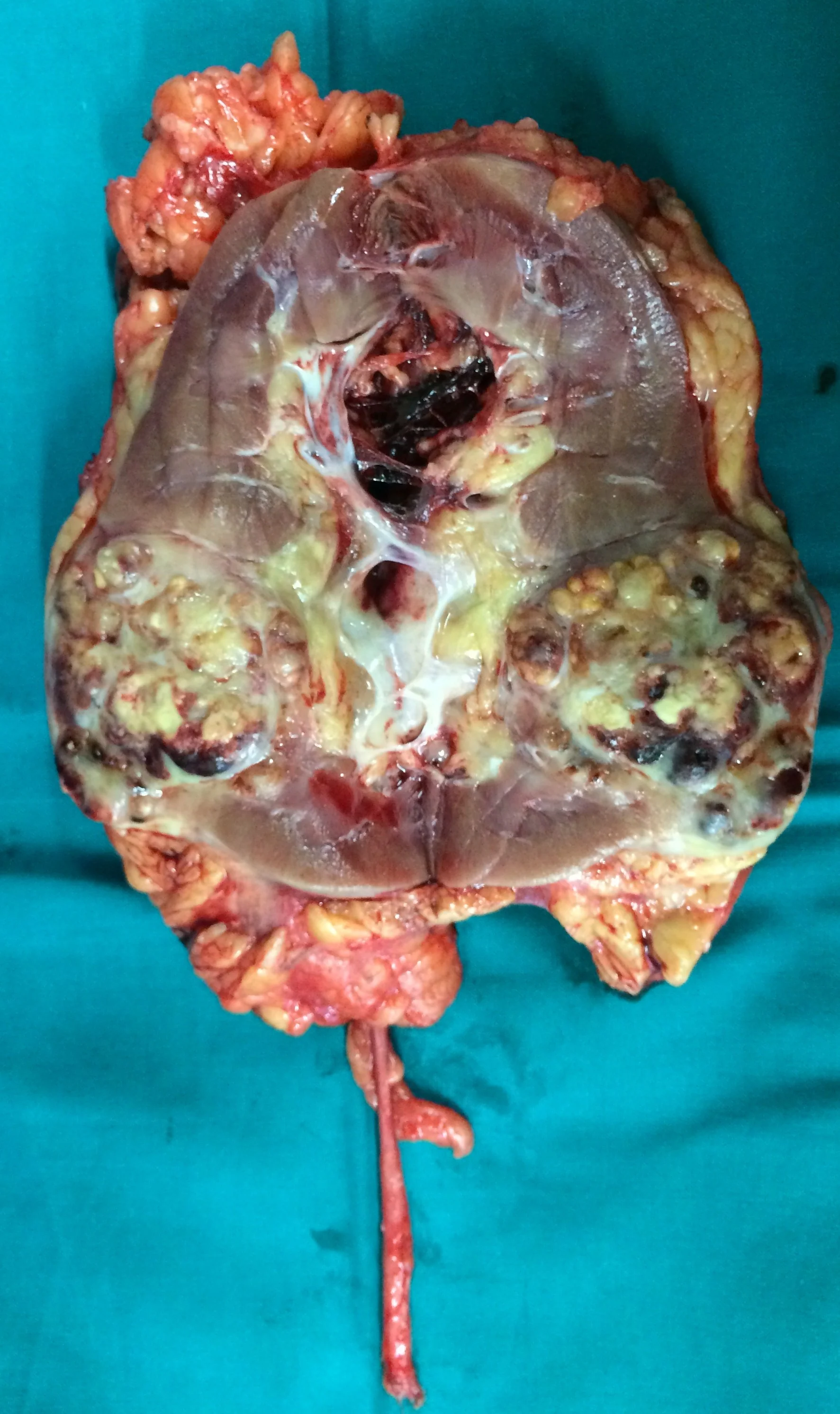 RENAL CARCINOMA
