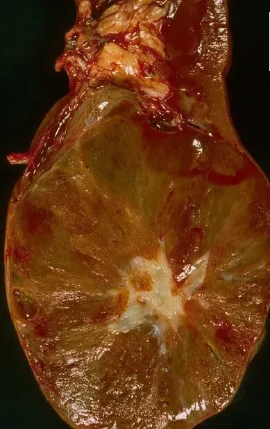 RENAL ONCOCYTOMA