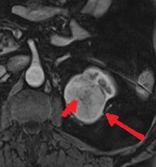 RENAL ONCOCYTOMA