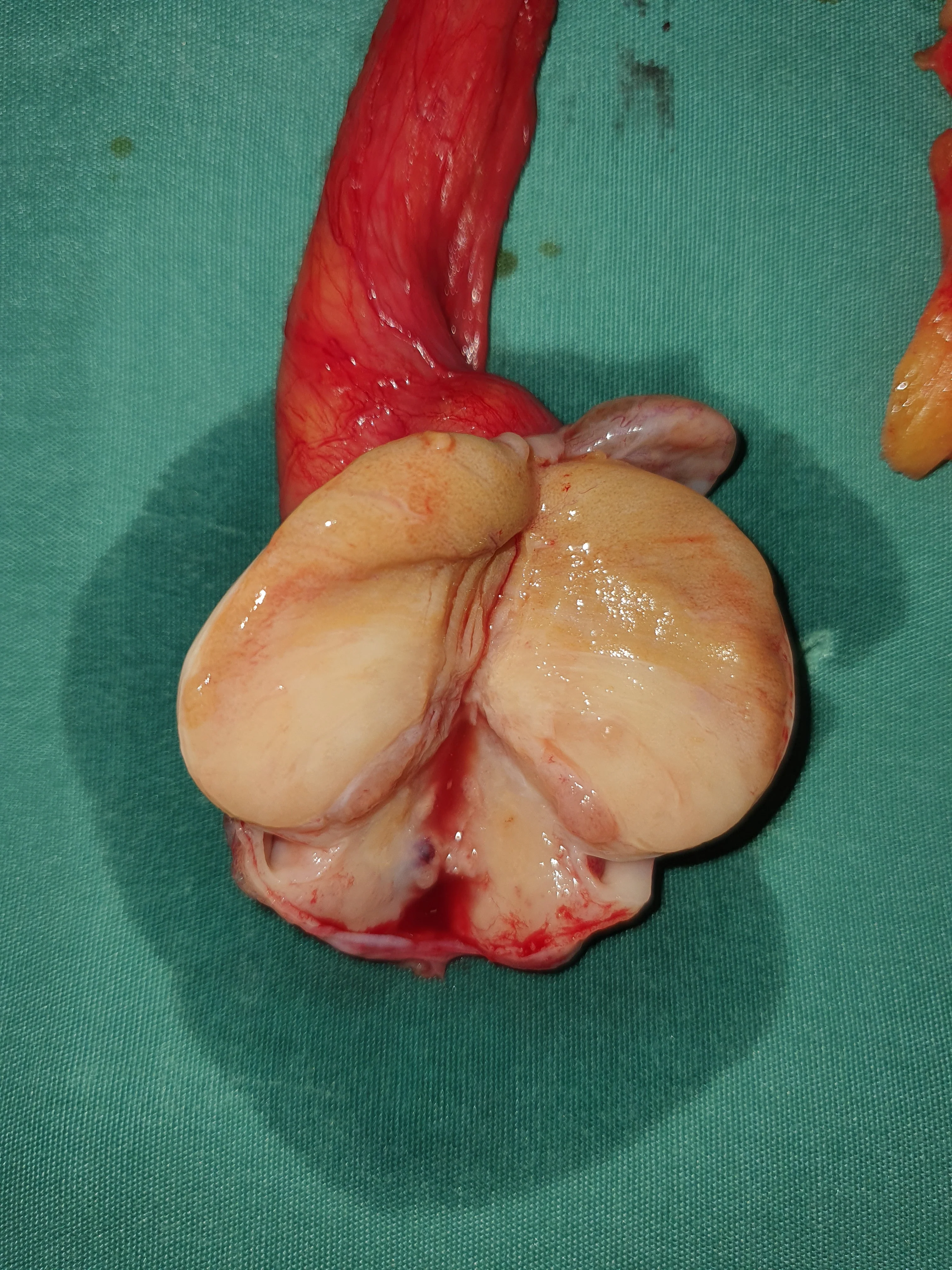 TESTICULAR SEMINOMA