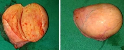 ABDOMINAL MASS - CRYPTORCHIDISM
