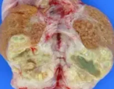 ACUTE EPIDIDYMO-ORCHITIS