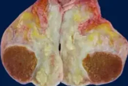 ACUTE EPIDIDYMO-ORCHITIS 