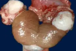 ADENOMATOID TUMOR