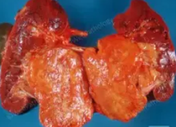 RENAL ANGIOMYOLIPOMA