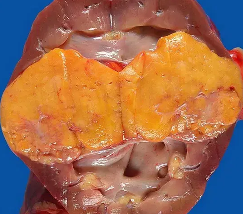 RENAL ANGIOMYOLIPOMA 