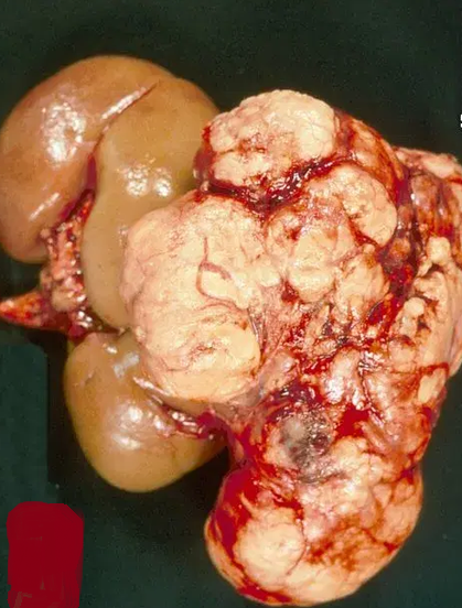 RENAL ANGIOMYOLIPOMA 