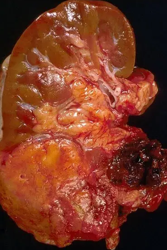 RENAL ANGIOMYOLIPOMA 