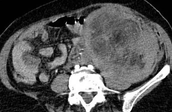 ANGIOMYOLIPOMA LEFT KIDNEY 