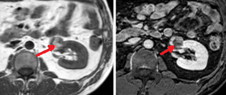 RENAL ANGIOMYOLIPOMA