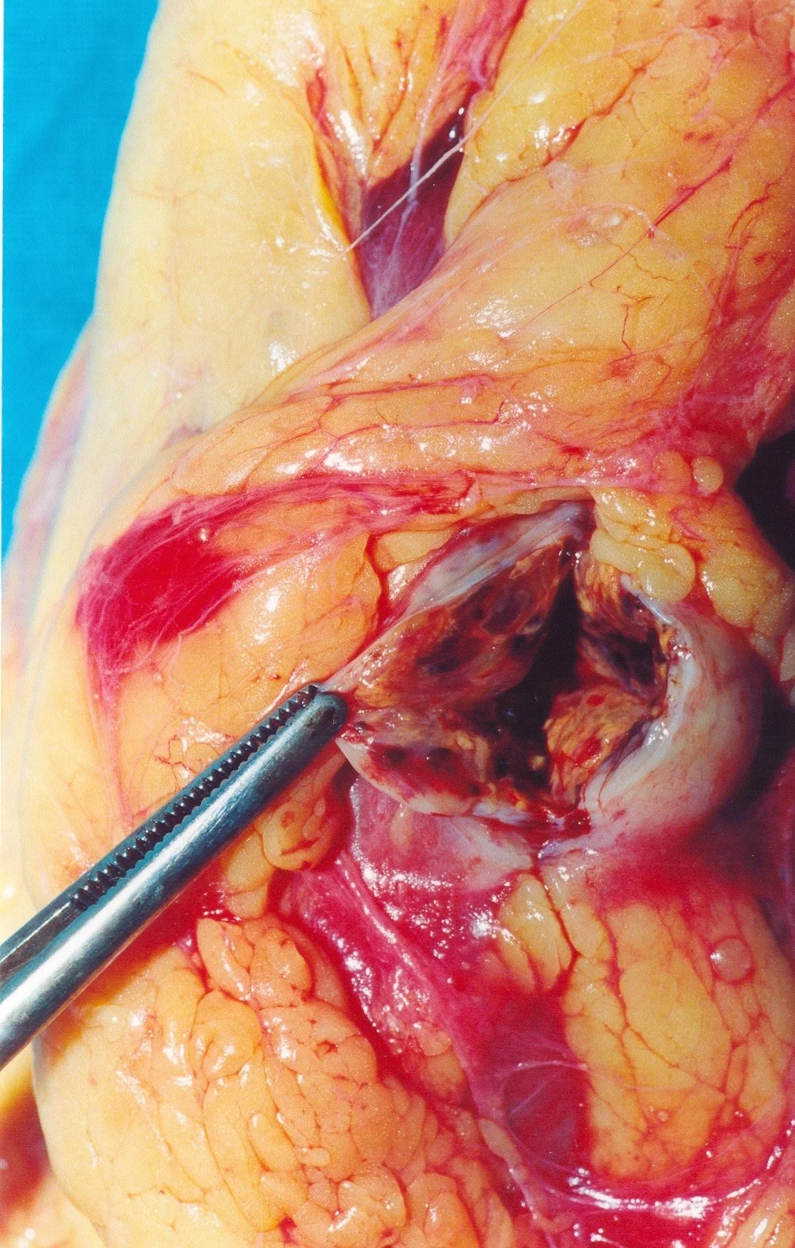 RENAL CARCINOMA