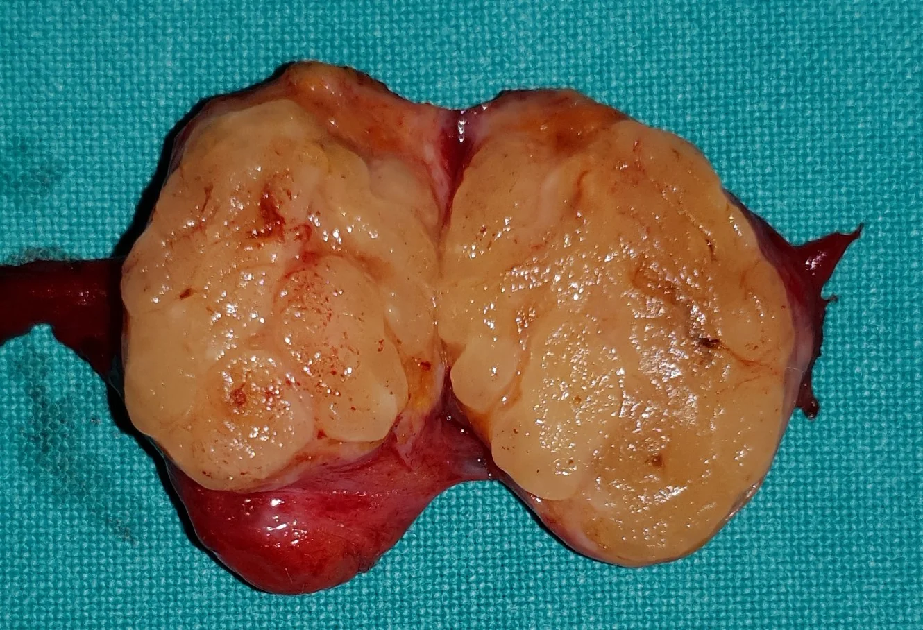 ATROPHIC TESTICLE