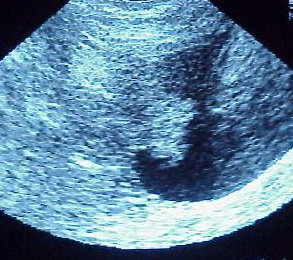 BLADDER TUMOR